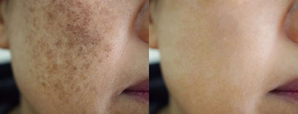 hyperpigmentation treatment