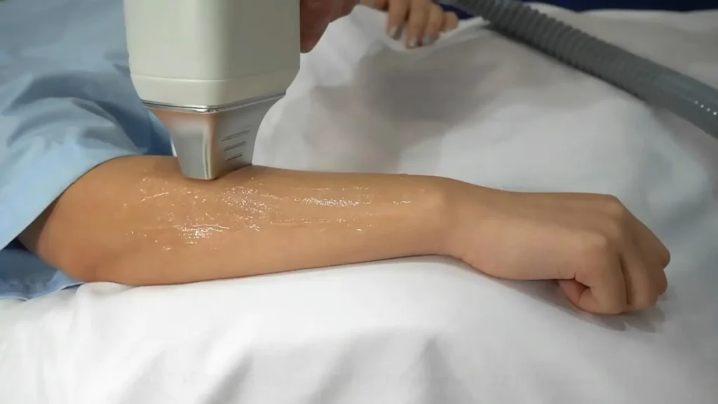 arm hair removal diode laser