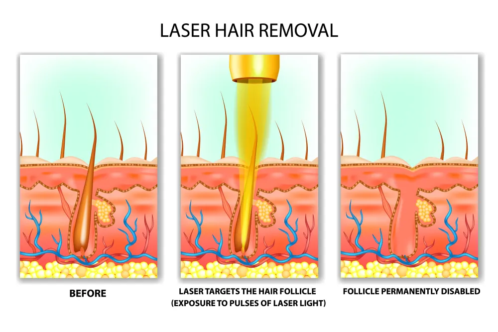 Laser Hair Removal Theory 2